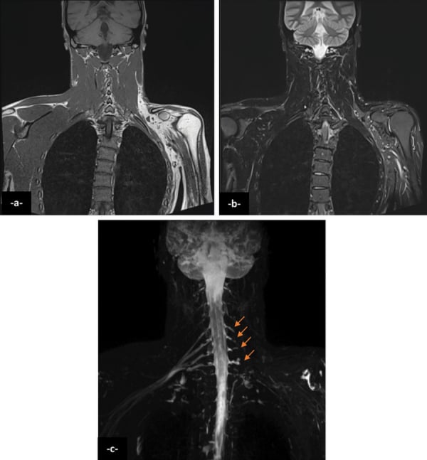 Three-panel MRI of the neck and shoulders, panels -a-, -b- and -c-; panel c is a fluid-weighted projection in which four arrows mark successive levels along one side of the cervical thecal sac.