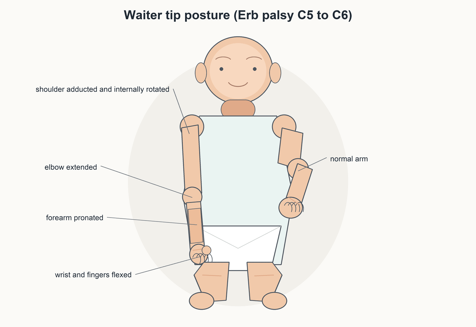Labelled schematic of an infant showing the waiter's-tip posture of Erb's palsy: affected arm adducted/internally rotated, elbow extended, forearm pronated, wrist and fingers flexed, beside a normally flexed arm.