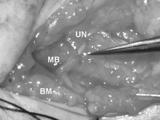 Intraoperative view of Oberlin partial ulnar nerve transfer