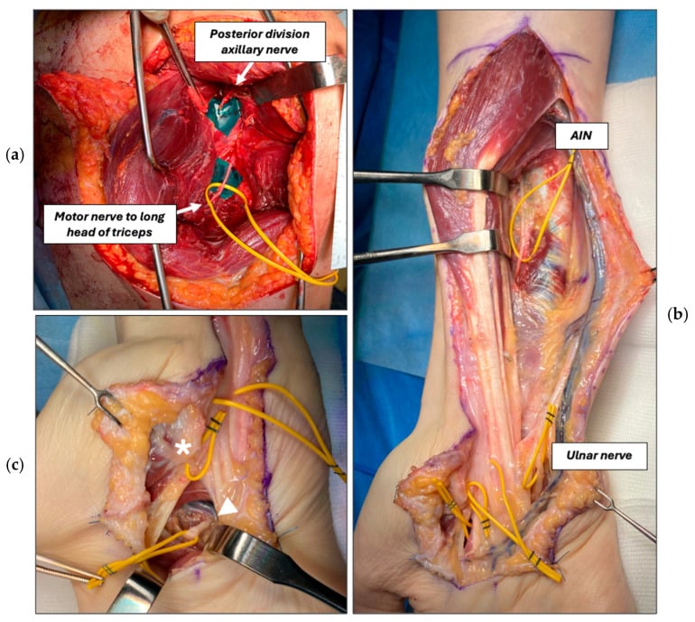 Intraoperative photographs of nerve transfer reconstruction with axillary and triceps motor branches identified