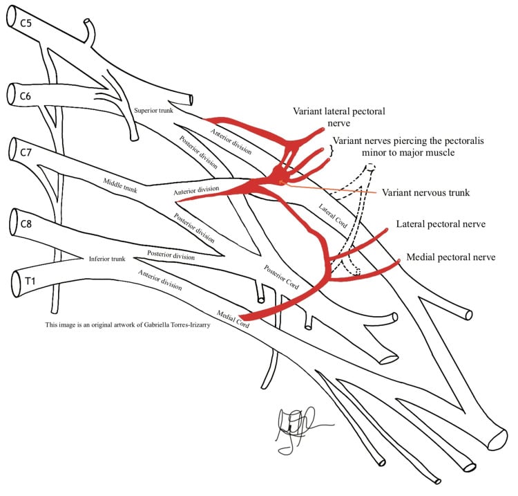 Schematic showing variant nerve origins overlaid on normal brachial plexus anatomy