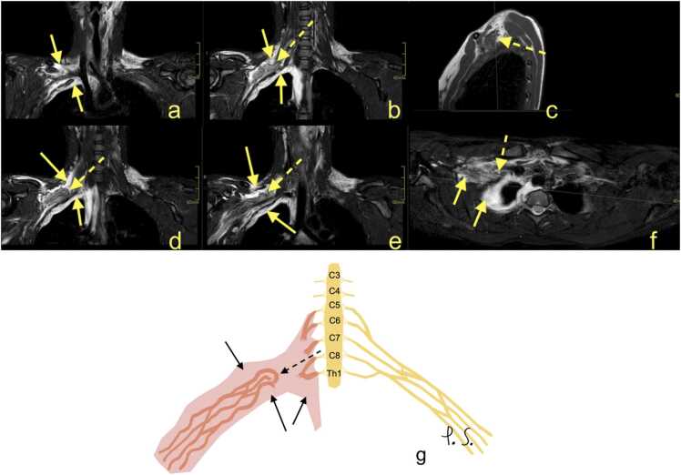 MR neurography of the brachial plexus using T2-weighted and T1-weighted sequences