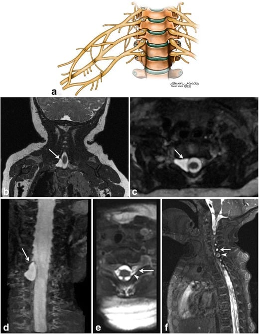 High-resolution brachial plexus imaging in neonates with a normal anatomical illustration for comparison
