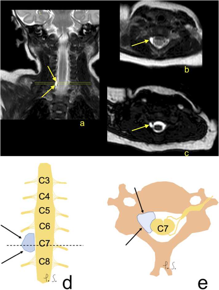 Brachial plexus imaging in a five-week-old infant with right-sided Erb's palsy