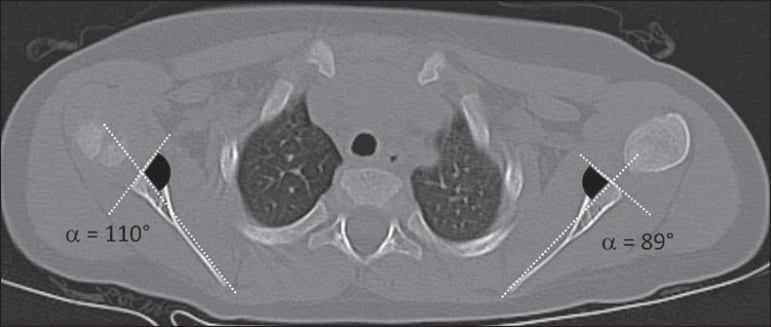 Axial CT showing a dysplastic right glenohumeral joint with the normal left side for comparison