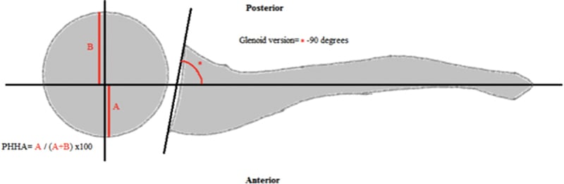 Diagram of the method for measuring percentage humeral head anterior and glenoid version