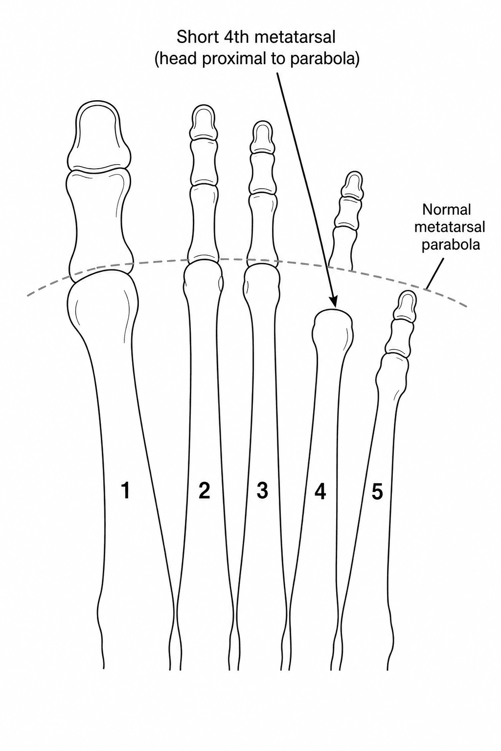 Labelled diagram of the forefoot skeleton showing a short fourth metatarsal with its head proximal to the normal metatarsal parabola
