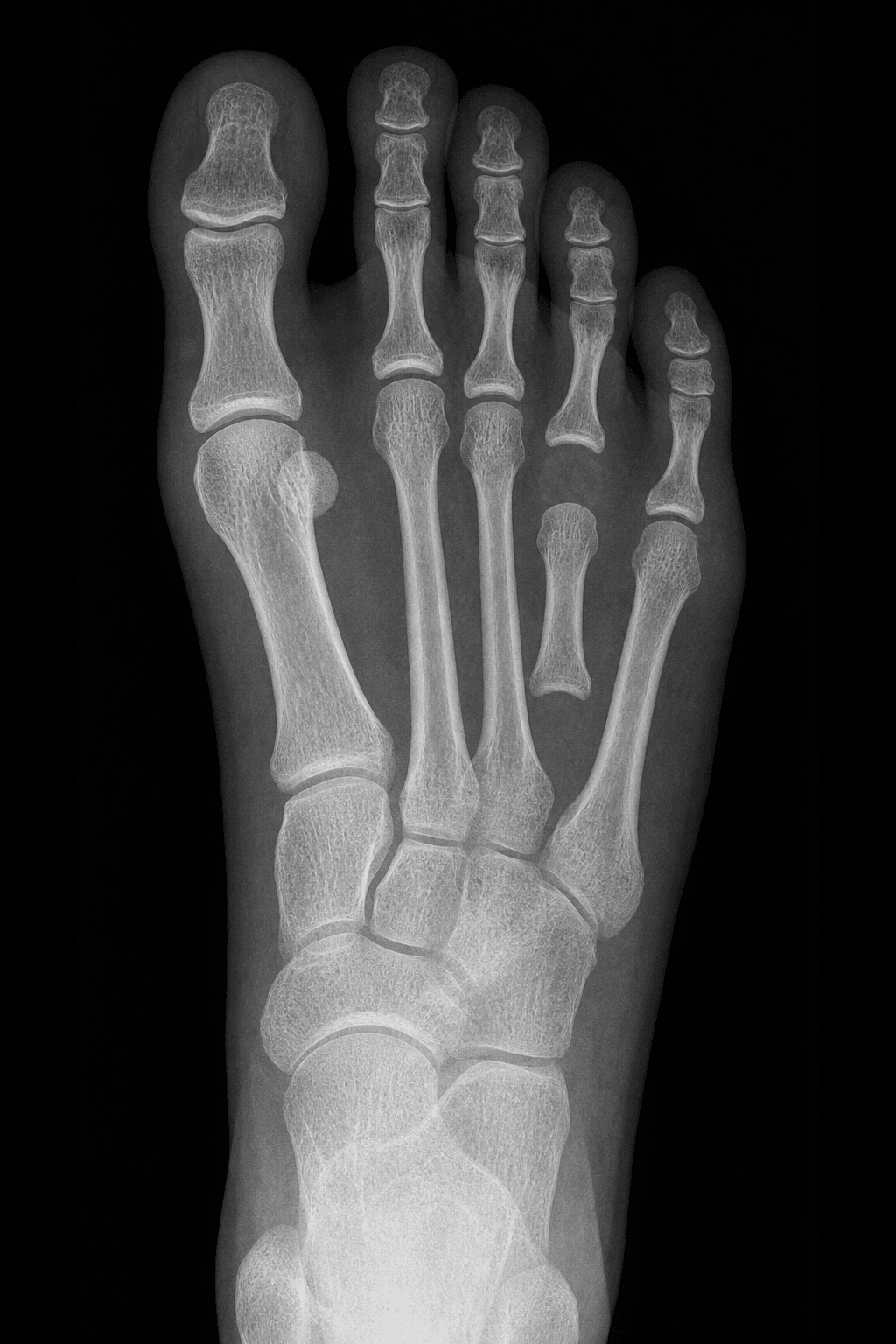 AP foot radiograph showing a short fourth metatarsal proximal to the metatarsal parabola