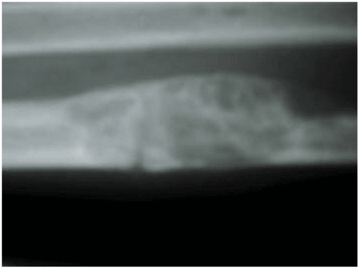 Lateral forearm radiograph showing an expansile lytic lesion with surrounding callus and healing