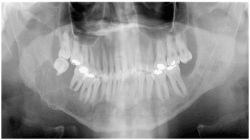 Dental panoramic radiograph showing a multilocular radiolucency of the right mandible