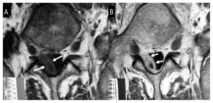 Two axial MR images with sagittal locators showing a right-sided brucellar epidural collection displacing the dural sac