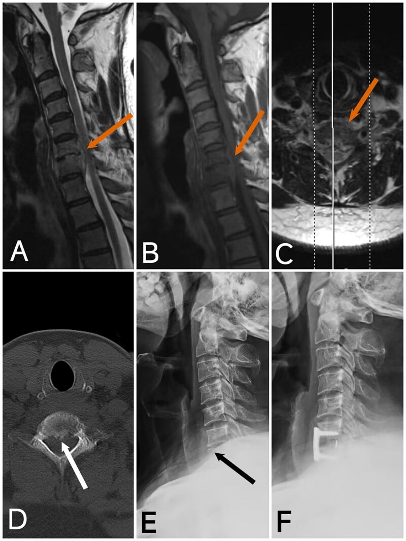 Sagittal and axial cervical MRI, axial CT and lateral radiographs of brucellar spondylodiscitis compressing the cord, before and after anterior plate fixation