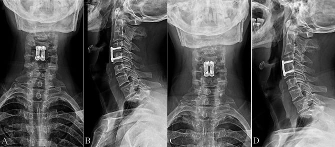 AP and lateral cervical radiographs with an anterior plate at a single level, at four and twenty-seven months after surgery for cervical brucellosis