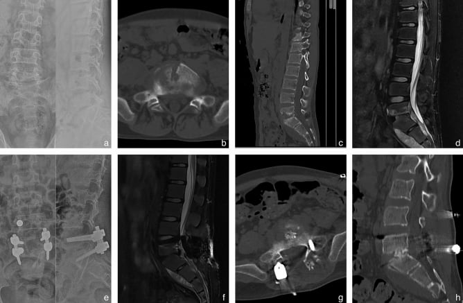 Preoperative radiographs, CT and MRI of lower lumbar brucellar spondylitis and postoperative imaging with posterior pedicle screw fixation