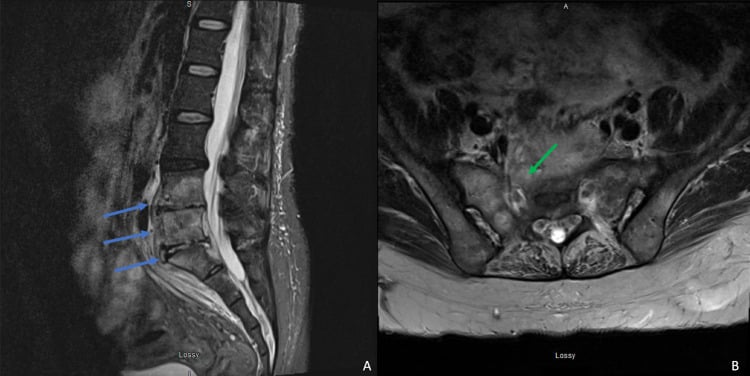 Four-month sagittal and axial follow-up MRI of multilevel lumbosacral brucellar disease