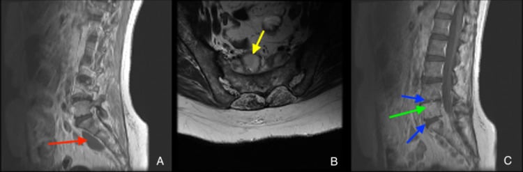Sagittal and axial MRI of lumbosacral brucellar osteodiscitis with a presacral collection
