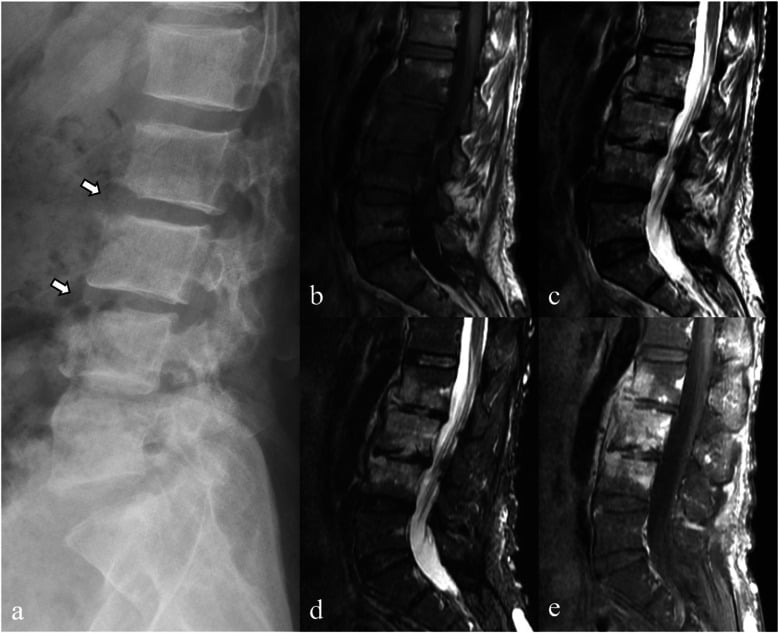 Lateral lumbar radiograph and sagittal MRI showing diffuse multilevel brucellar spondylodiscitis