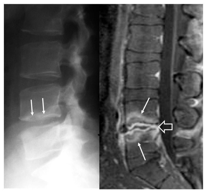 Lateral lumbar radiograph with subtle endplate change and sagittal MRI showing signal change in both endplates and the disc of early brucellar spondylodiscitis