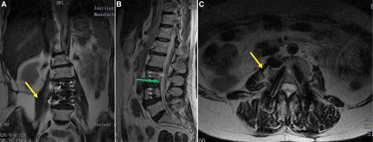 Twelve-month coronal, sagittal and axial follow-up MRI with arrows at the psoas and epidural sites