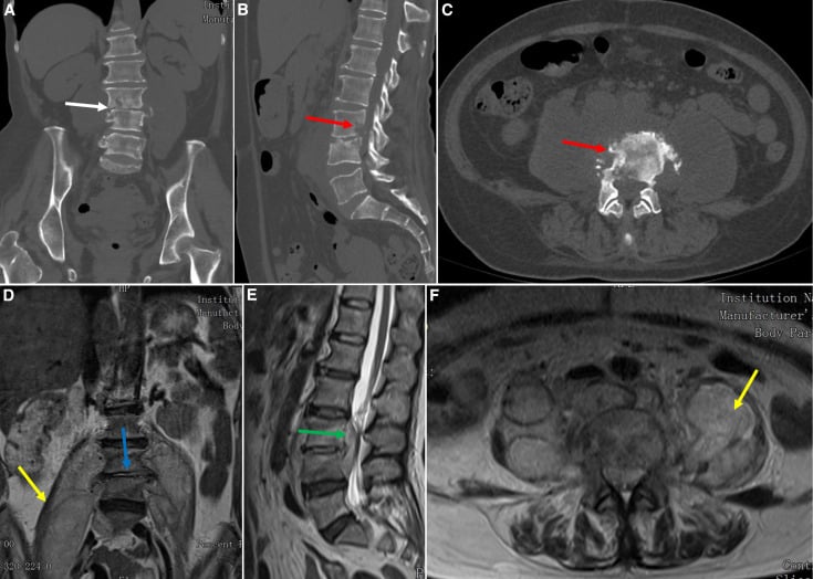 Coronal, sagittal and axial CT and MRI of lumbar brucellar spondylodiscitis with psoas collections and epidural extension