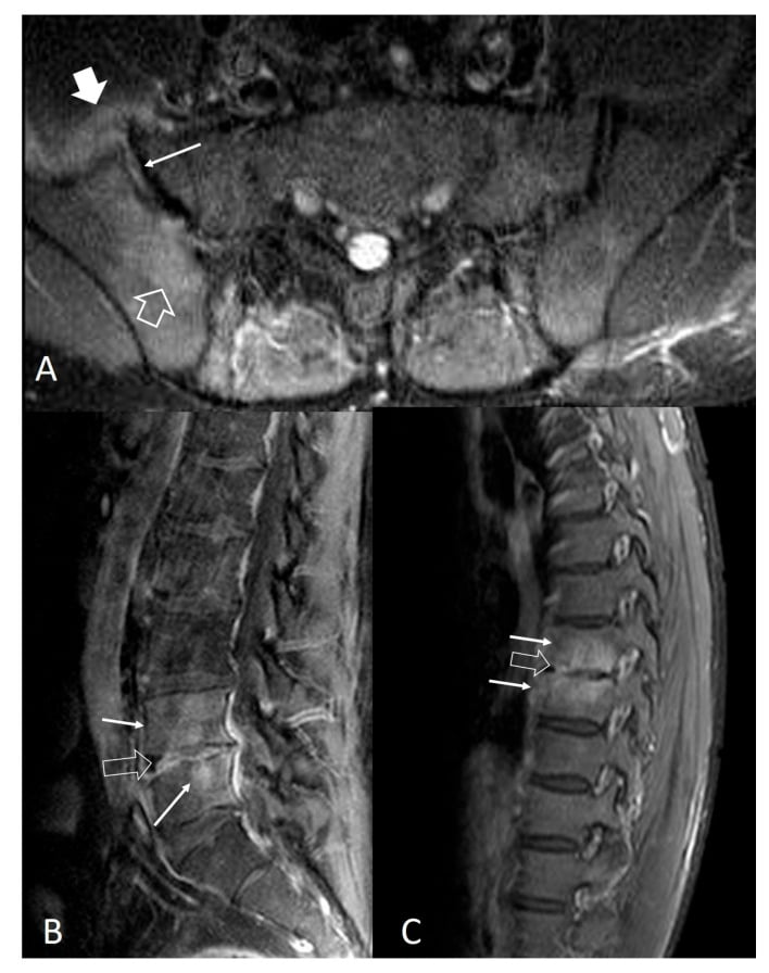 MRI showing right sacroiliitis (A) with separate lumbar (B) and thoracic (C) brucellar spondylodiscitis