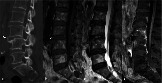 Sagittal CT showing erosion of the anterosuperior corner of L4, with sagittal MR images of the same segment