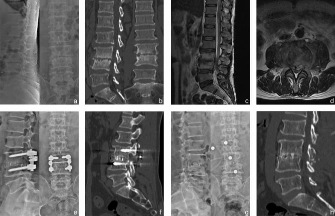 Lumbar brucellar spondylitis before surgery, after posterior pedicle screw fixation, and after implant removal