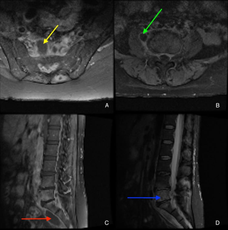 Axial and sagittal MRI showing presacral and right psoas collections with lower lumbar vertebral marrow involvement