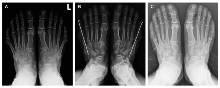Weightbearing AP foot radiographs demonstrating 5th metatarsal distal osteotomy