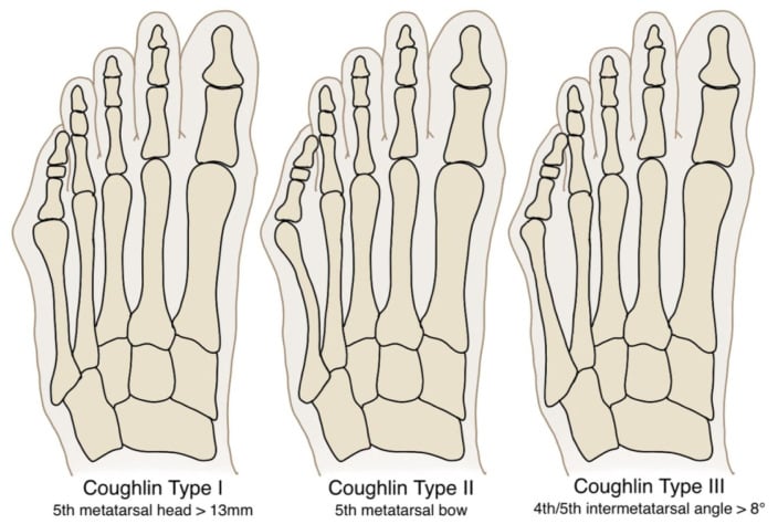 Anatomical schematic diagram of Coughlin's bunionette deformity classification