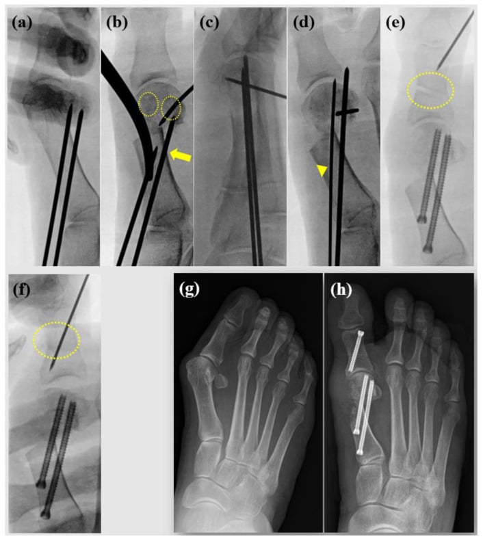Intraoperative fluoroscopy series of percutaneous 5th metatarsal Chevron osteotomy