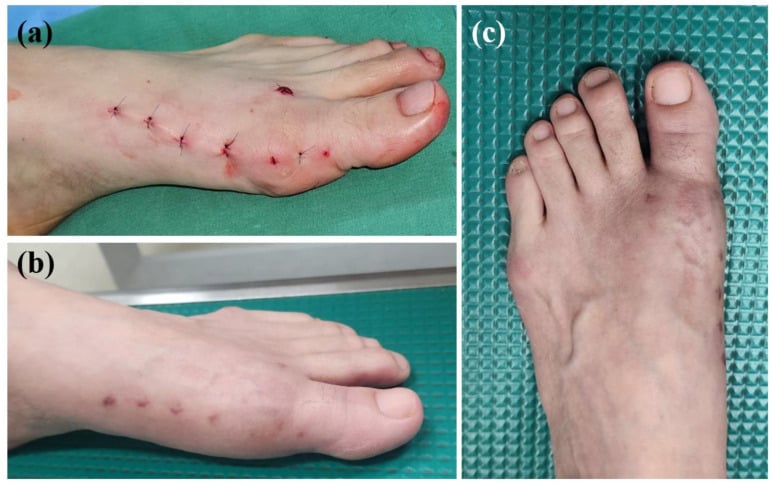 Postoperative clinical photographs of skin portals following percutaneous 5th metatarsal osteotomy
