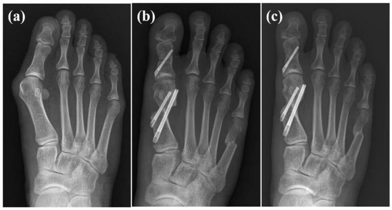 Weightbearing AP foot radiographs showing 4-5 intermetatarsal angle correction over 1 year
