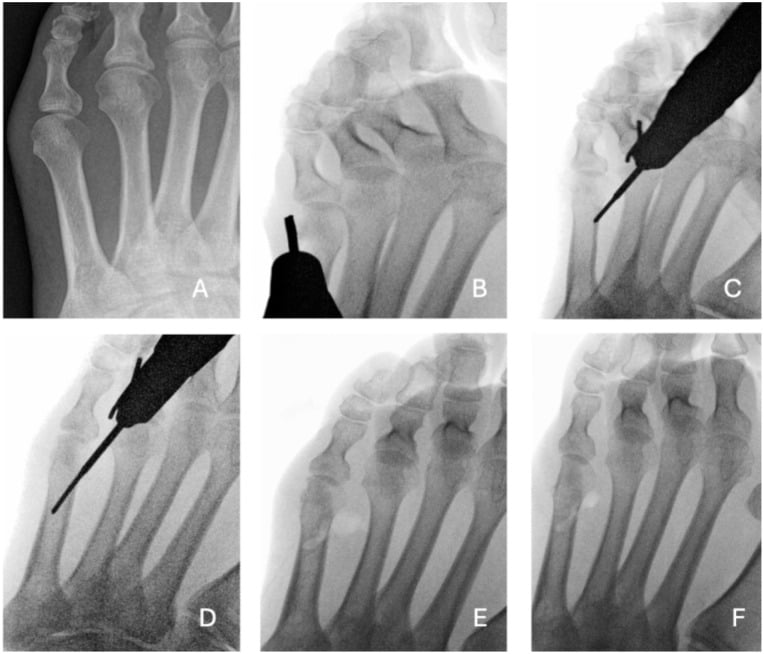 Fluoroscopic sequence of percutaneous bunionette correction using a Shannon burr