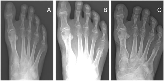 Weightbearing AP foot radiographs demonstrating 5th metatarsal distal osteotomy correction