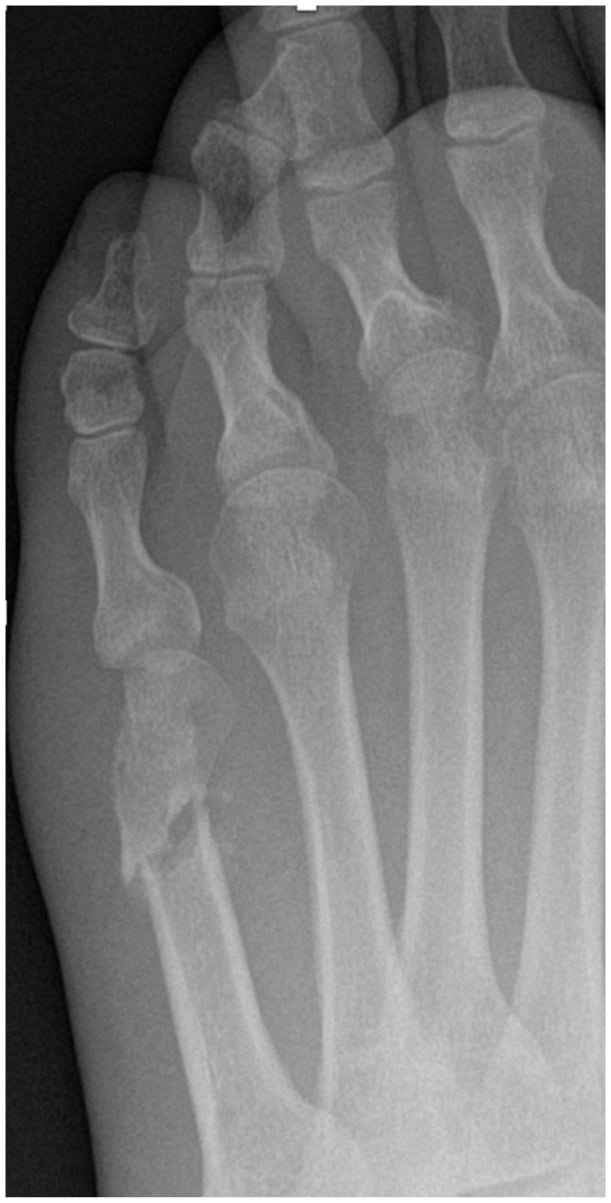 AP foot radiograph demonstrating 5th metatarsal osteotomy nonunion