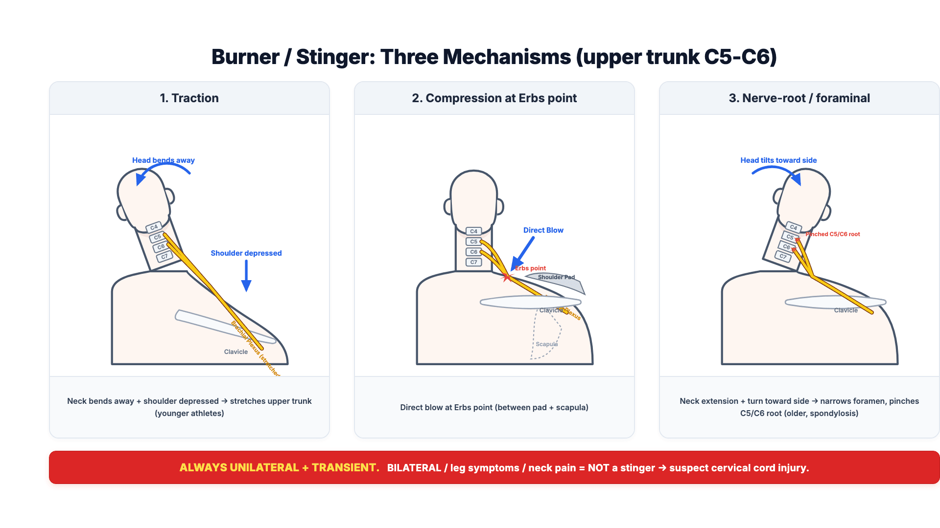 Three-panel diagram of the mechanisms of a burner/stinger: traction of the upper trunk, compression at Erb's point, and nerve-root/foraminal compression, with the bilateral red-flag rule
