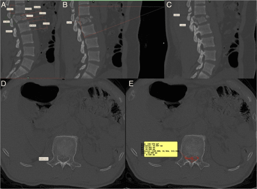 CT assessment parameters for thoracolumbar burst fractures