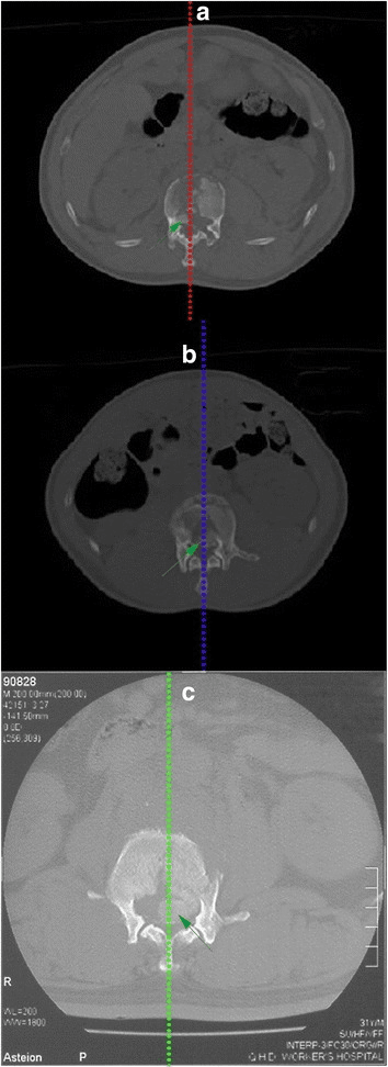 Axial CT showing different positions of retropulsed fragments