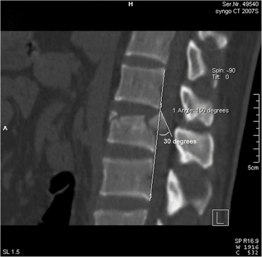 Sagittal CT of thoracolumbar burst fracture with kyphosis measurement