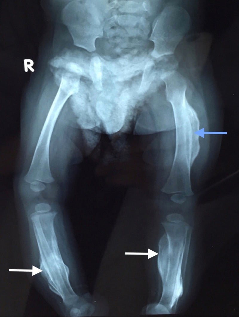 Frontal radiograph of an infant's pelvis and lower limbs showing lamellated periosteal new bone around the left femur (blue arrow) and both tibiae (white arrows)