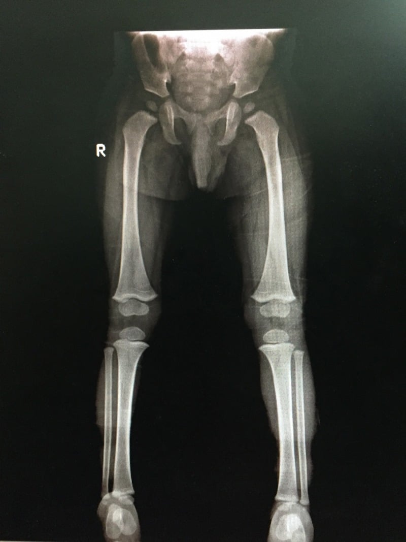 Follow-up frontal radiograph of both lower limbs, 2.5 years later, showing normal femoral and tibial contours after Caffey disease
