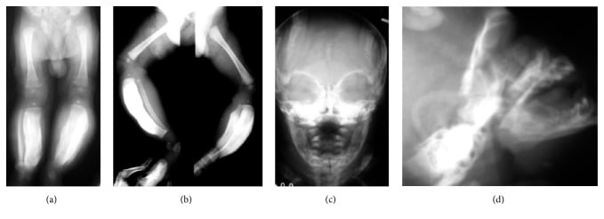Four-panel composite of infant radiographs: (a) and (b) lower limbs with thickened tibiae, (c) frontal skull and (d) lateral mandible showing mandibular cortical overgrowth