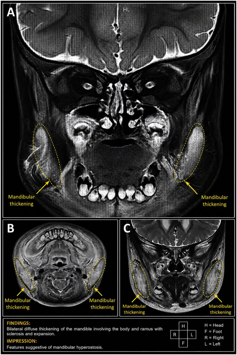 Three-panel MRI (A to C) with bilateral mandibular thickening outlined and labelled; the printed findings describe diffuse thickening of the mandibular body and ramus with sclerosis and expansion