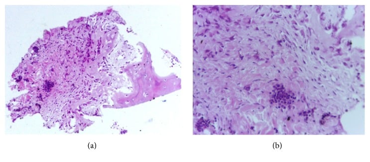 Two histology panels of a periosteal biopsy in Caffey disease: (a) fibroblastic proliferation with pink osteoid and (b) a higher-power field with focal lymphocytic clusters