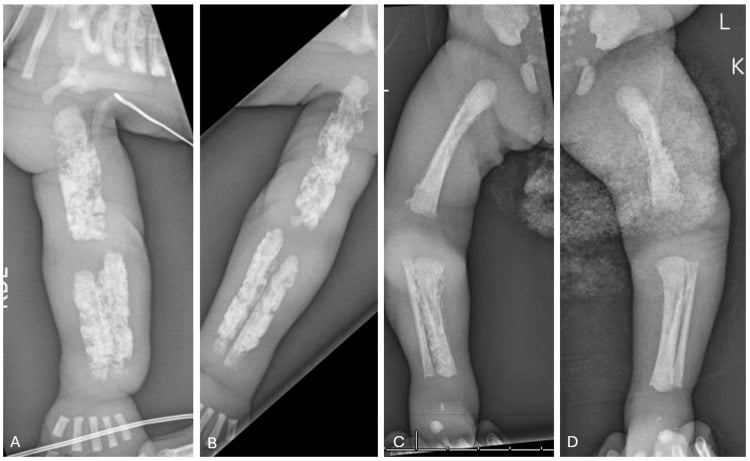 Four-panel birth radiographs (A to D) of the humeri and femora showing severe diffuse cotton-wool hyperostosis in prenatal Caffey disease