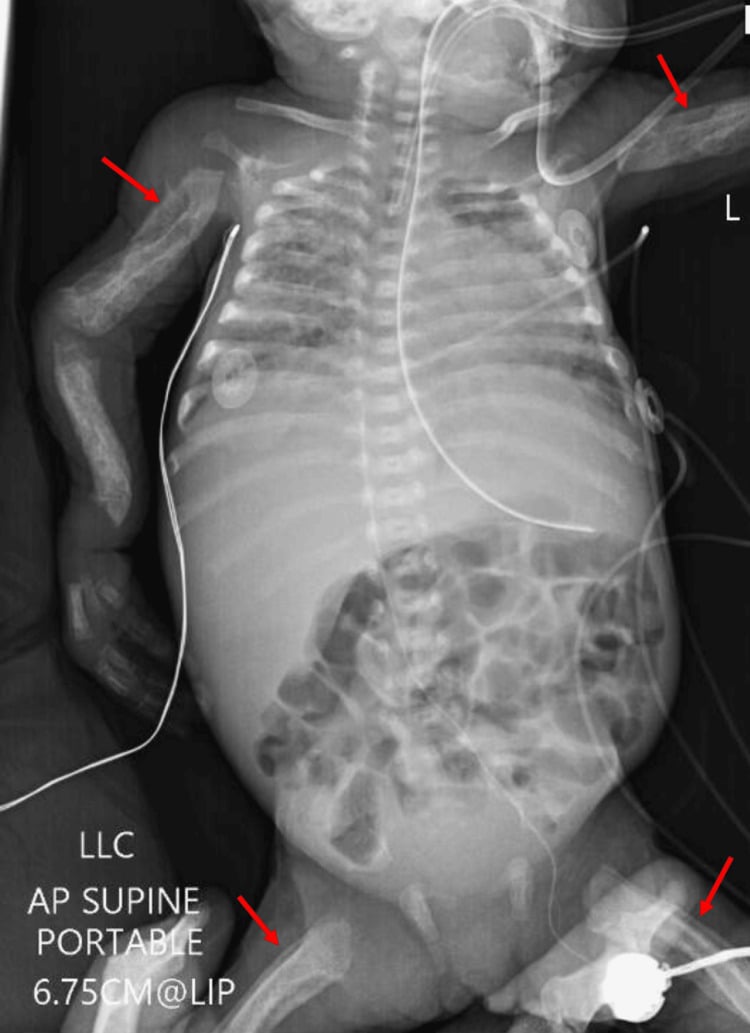 Three-week supine babygram with red arrows at both humeri and both femora showing double-cortex periosteal remodelling in severe prenatal Caffey disease