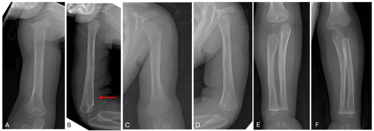 Two-year radiographs of the humeri (A to D) and forearms (E, F) showing near-complete resolution after severe prenatal Caffey disease