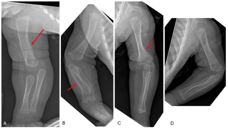 Five-month upper-limb radiographs (A to D) showing marked improvement with residual periosteal reaction (arrows)