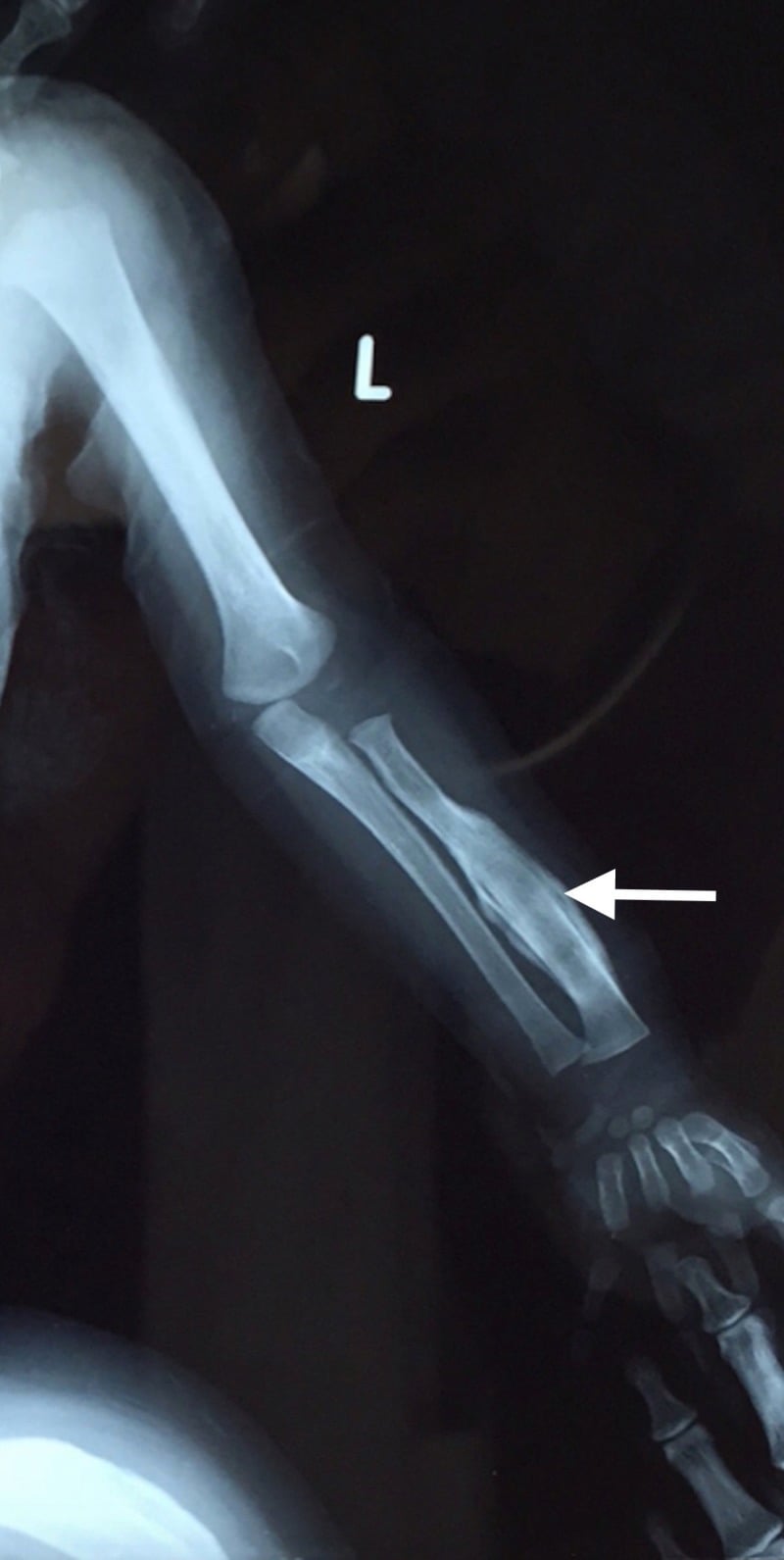 Infant left forearm radiograph showing thick periosteal new bone around the radial diaphysis (arrow) with metaphyseal sparing